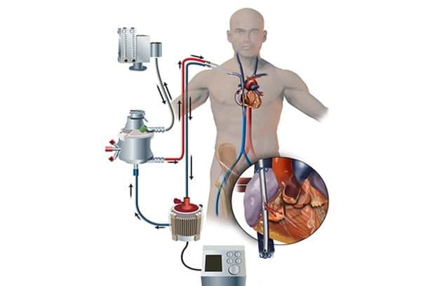 ECMO medicina come funziona - morte in standby