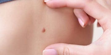 Vaccino per il melanoma