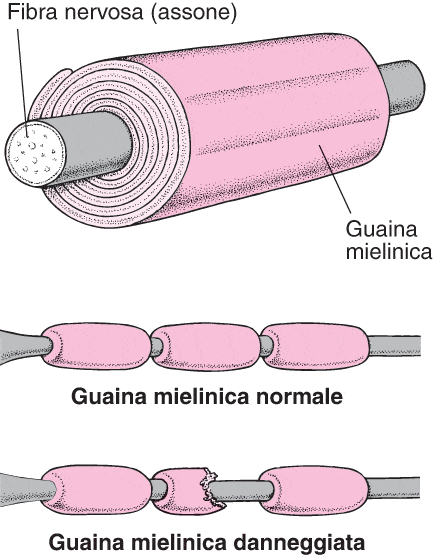 sclerosi multipla