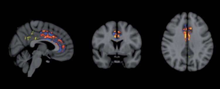 alzheimer
