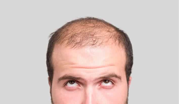 Característica de caída del cabello