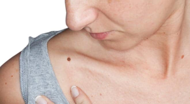 DIRC3, pare o melanoma