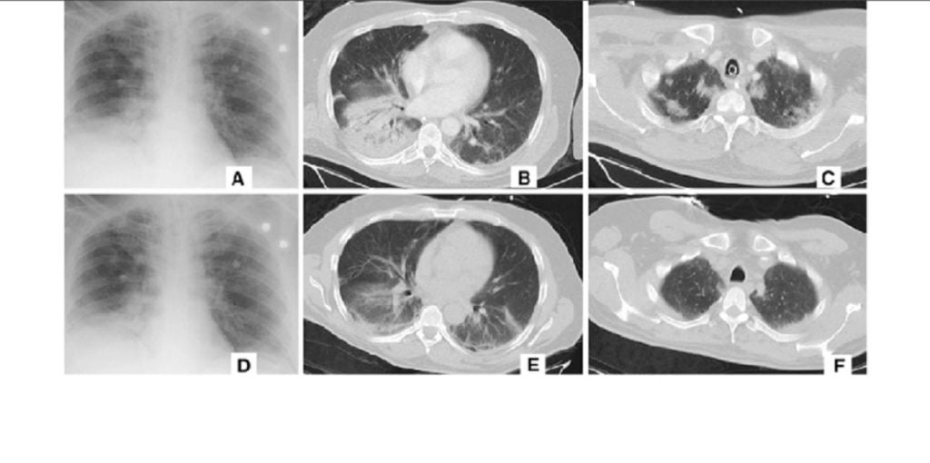 scans thoraciques du coronavirus