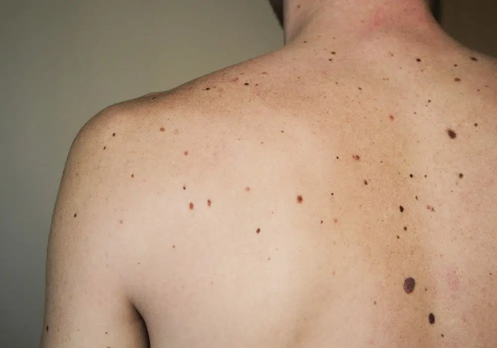 Vaccino melanoma recidive