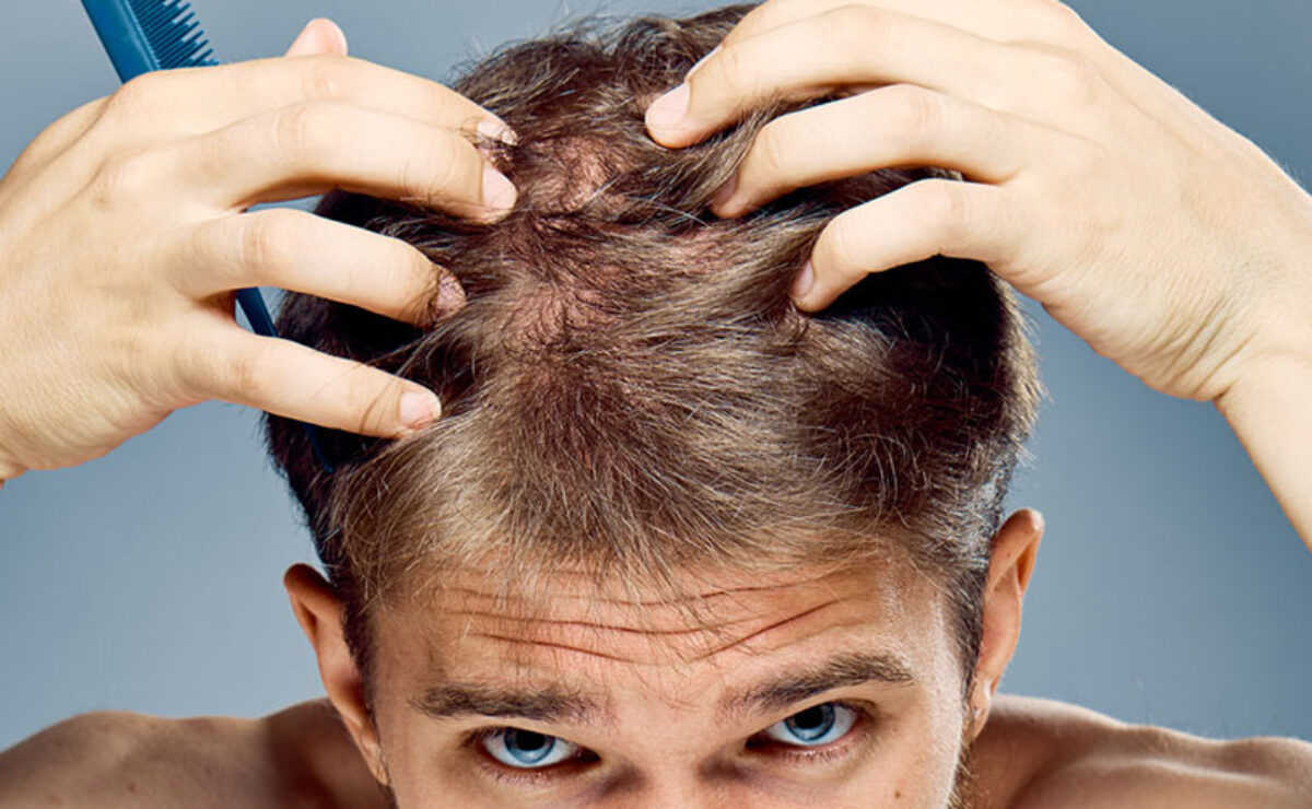 Calvizie Stavolta Ci Siamo I Ricercatori Potrebbero Averla Sconfitta