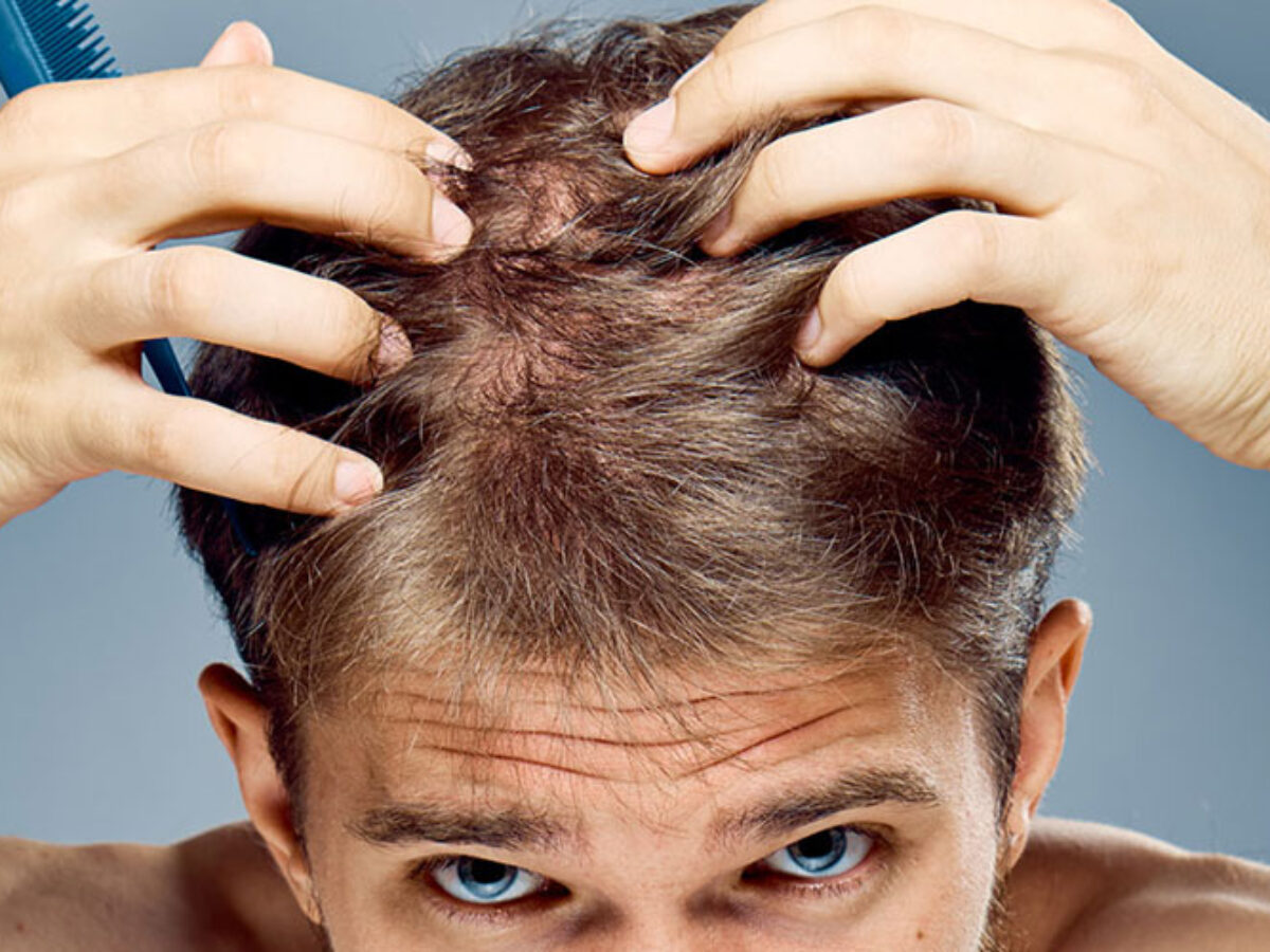 Calvizie Stavolta Ci Siamo I Ricercatori Potrebbero Averla Sconfitta