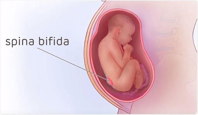 spina bifida