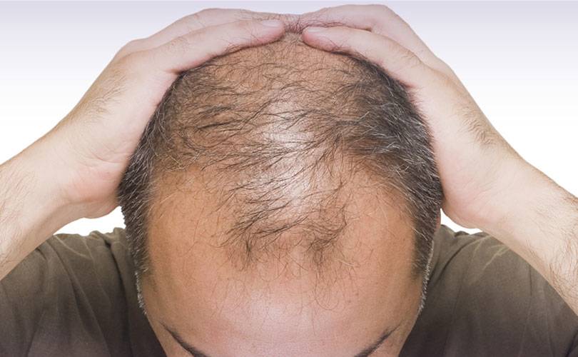 male pattern baldness