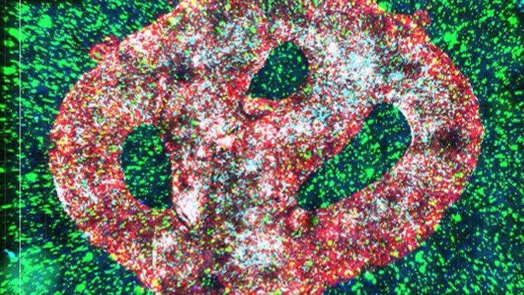Tumor cerebral