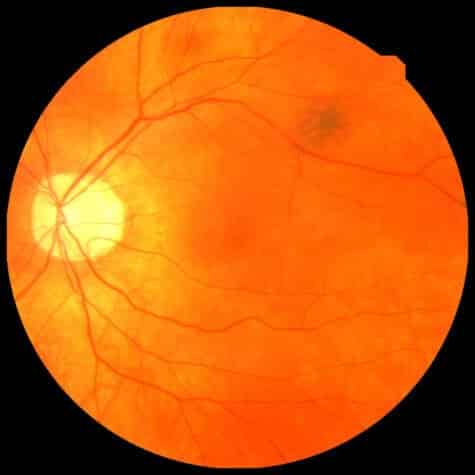 Infarto retina