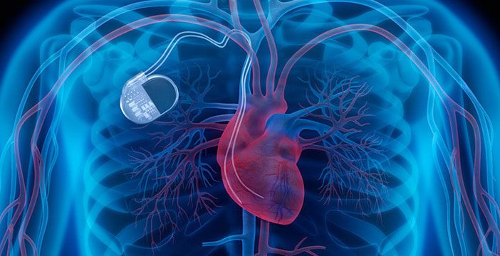 Pacemaker