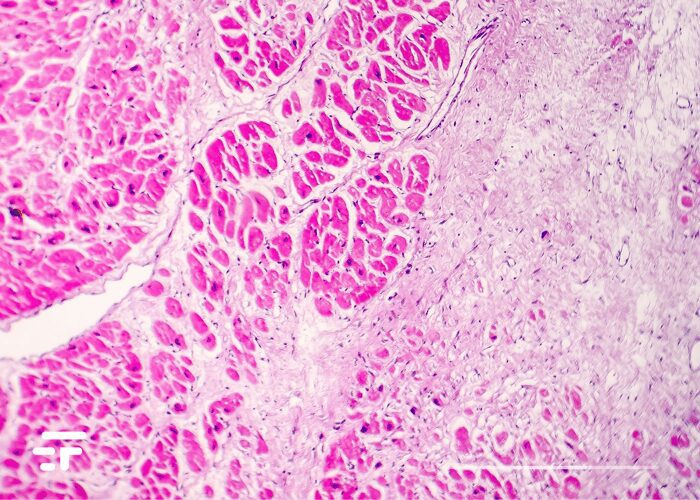 Eliminare proteina per impedire infarti e ictus