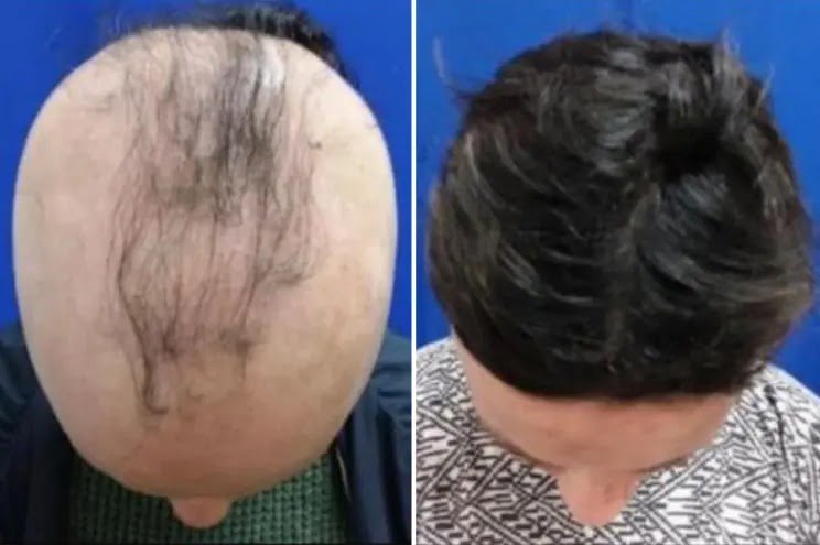 farmaco alopecia