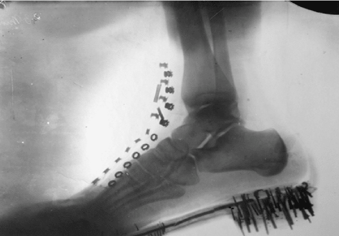 Salpetersäure-Radiographie