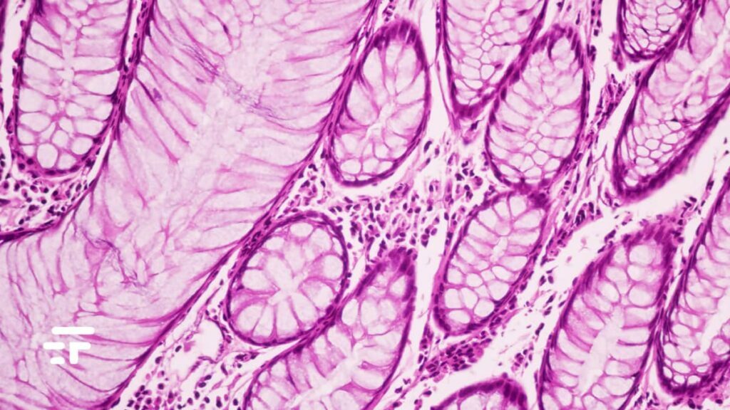 vaccino mRNA melanoma