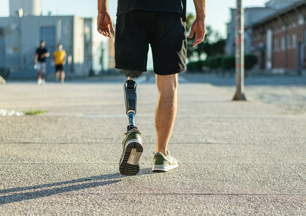 62a83c7086f88f844e71a3eb Can you walk normally with a prosthetic leg