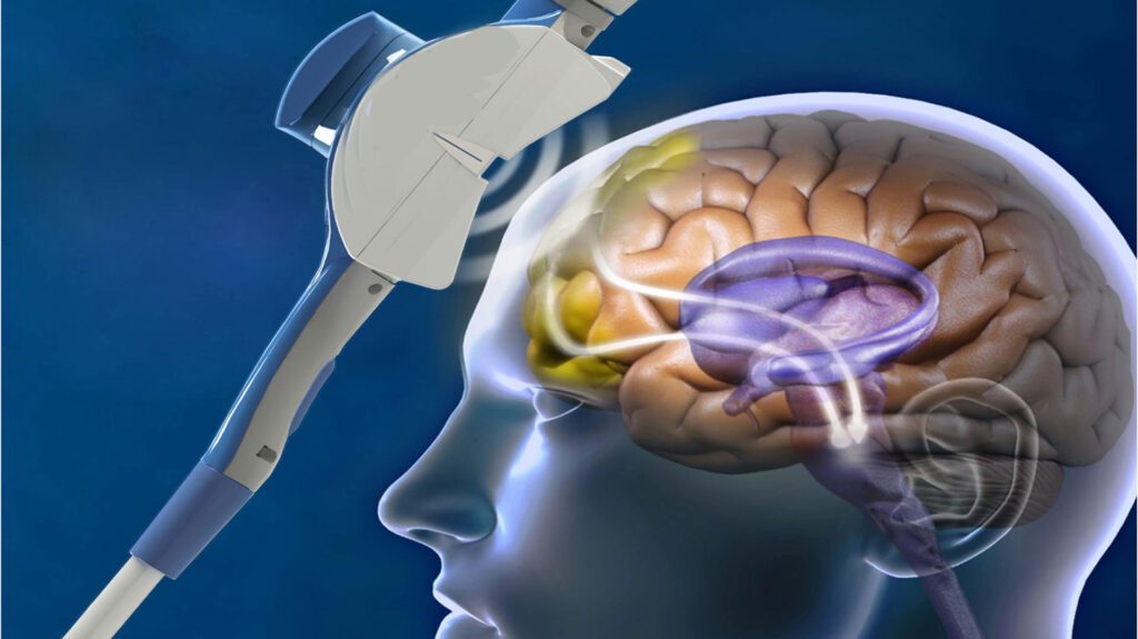 Transcranial magnetic stimulation