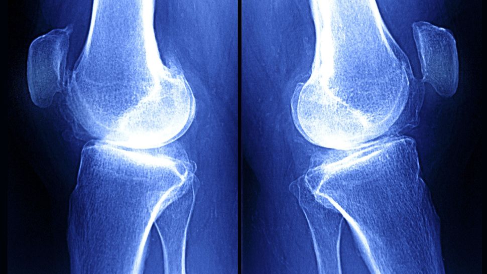 Osteoartrite