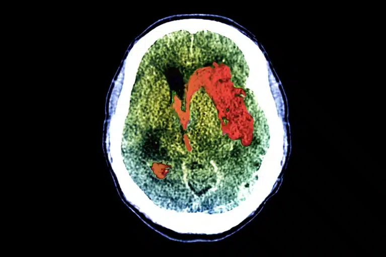 Neuroimaging