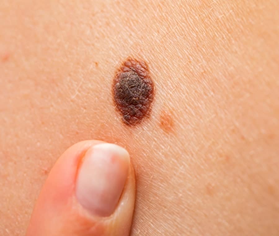 Carcinoma