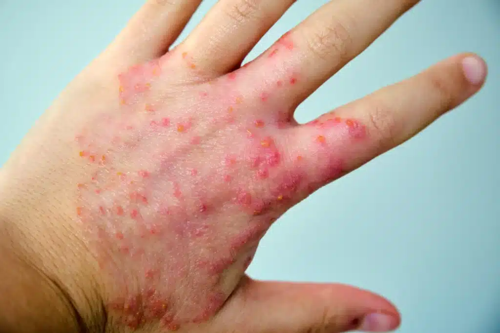 Eczema