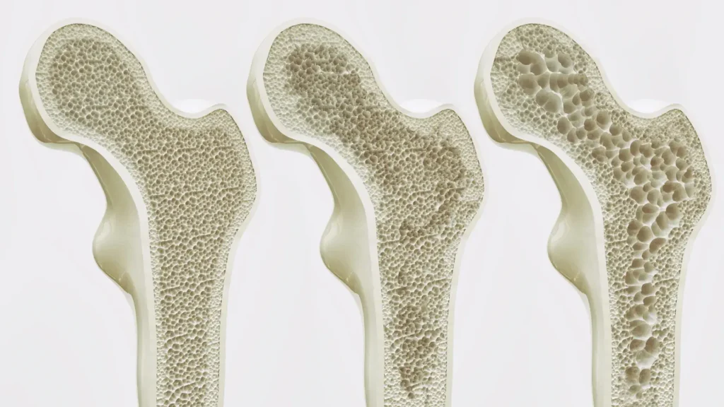 osteoporosi