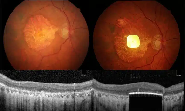 Ricercatore analizza impianto retinico PRIMA in laboratorio oftalmologico