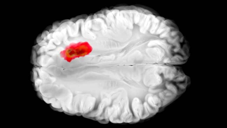 idralazina glioblastoma ricerca laboratorio cellule tumorali