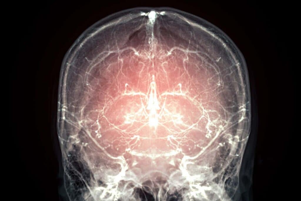 Congelare il cervello