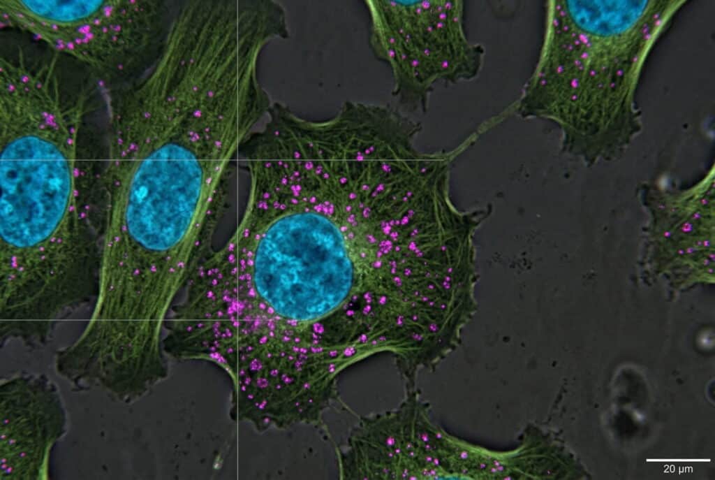 Cellule prive della proteina TBC1D9B mostrano lisosomi dispersi: il riciclo cellulare perde organizzazione