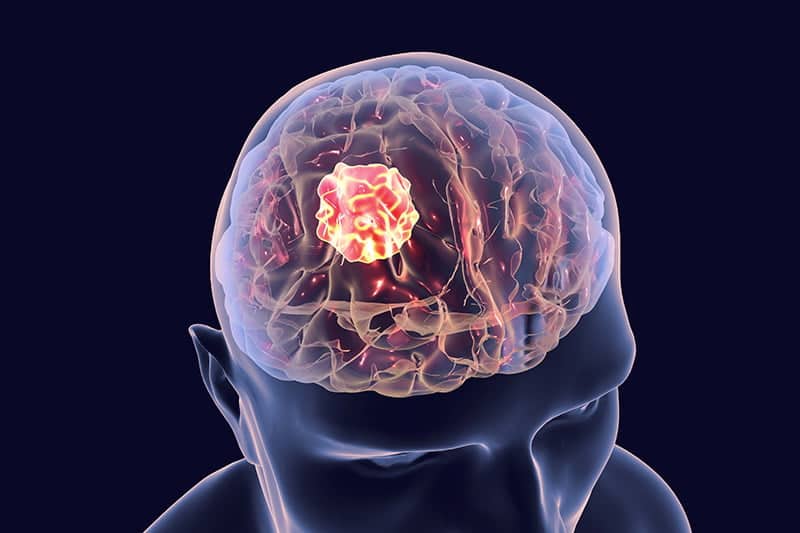 Glioblastoma, nei test pre-clinici sui topi 83% di guarigioni