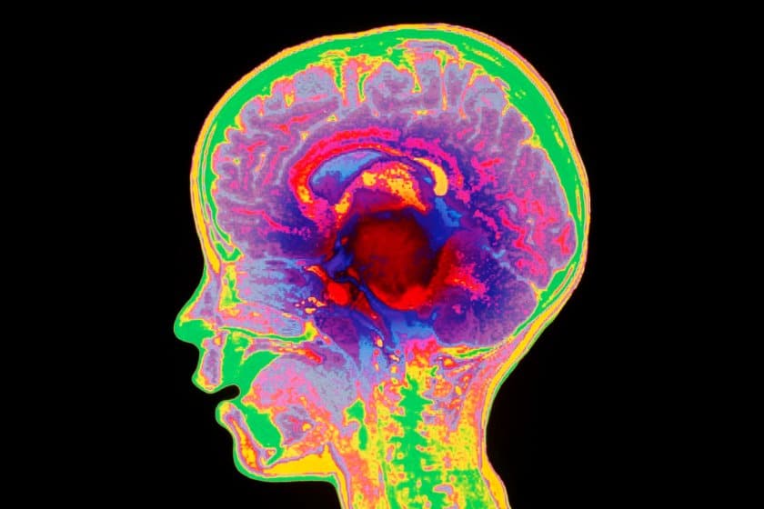 Tumore cerebrale