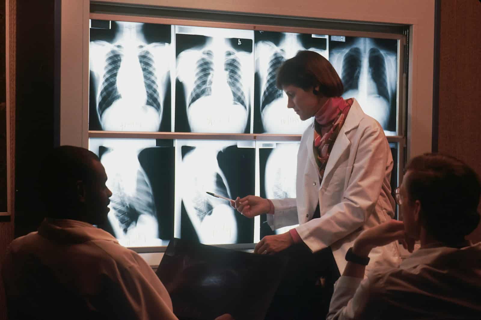 Una radiologa indica una radiografia del torace davanti a una parete di lastre, con due colleghi in primo piano: da esami così si cerca di intercettare il cancro al polmone